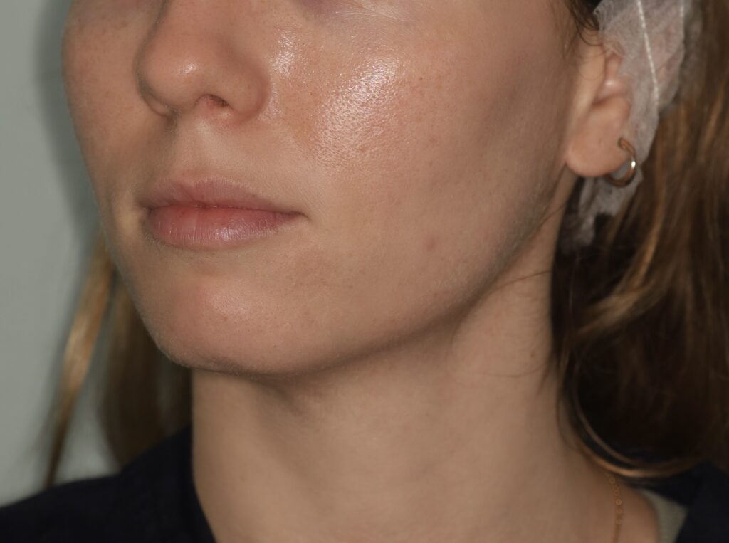 Estética facial: Electroestimulación, Radiofrecuencia, peelings químicos superficiales y Nanopore Pen