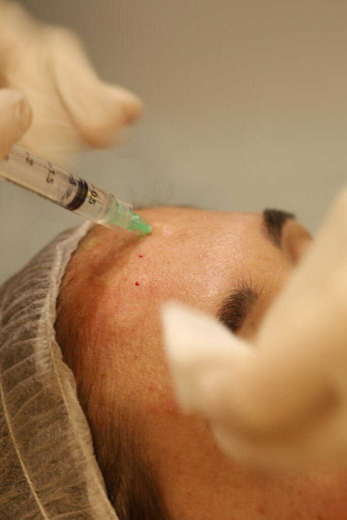 En Clínicas Dental Esteve ofrecemos tratamientos de medicina estética facial destinados a suavizar los signos del envejecimiento, mejorar la armonía del rostro y conseguir resultados naturales y adaptados a cada paciente. -Toxina botulínica: La toxina botulínica se infiltra en puntos concretos de la musculatura facial para reducir temporalmente su contracción. Su finalidad es suavizar las arrugas de expresión, especialmente en zonas como el entrecejo, la frente o el contorno de los ojos, manteniendo la naturalidad del rostro. -Ácido hialurónico: El ácido hialurónico es una sustancia biocompatible que se infiltra para aportar hidratación, recuperar volumen, mejorar determinados contornos faciales y suavizar surcos o arrugas. También puede utilizarse para armonizar zonas como los labios, el mentón o los pómulos, siempre según las necesidades de cada paciente. Estos tratamientos son realizados por el Dr. Esteve, médico y odontólogo, tras una valoración profesional individualizada. En muchos casos se combinan con nuestros tratamientos de estética facial, ya que no solo se tiene en cuenta la expresión y la estructura del rostro, sino también el estado, la calidad y las necesidades de la piel.