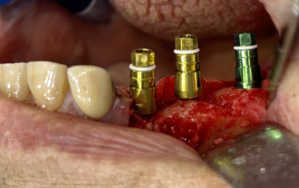 Implantes dentales